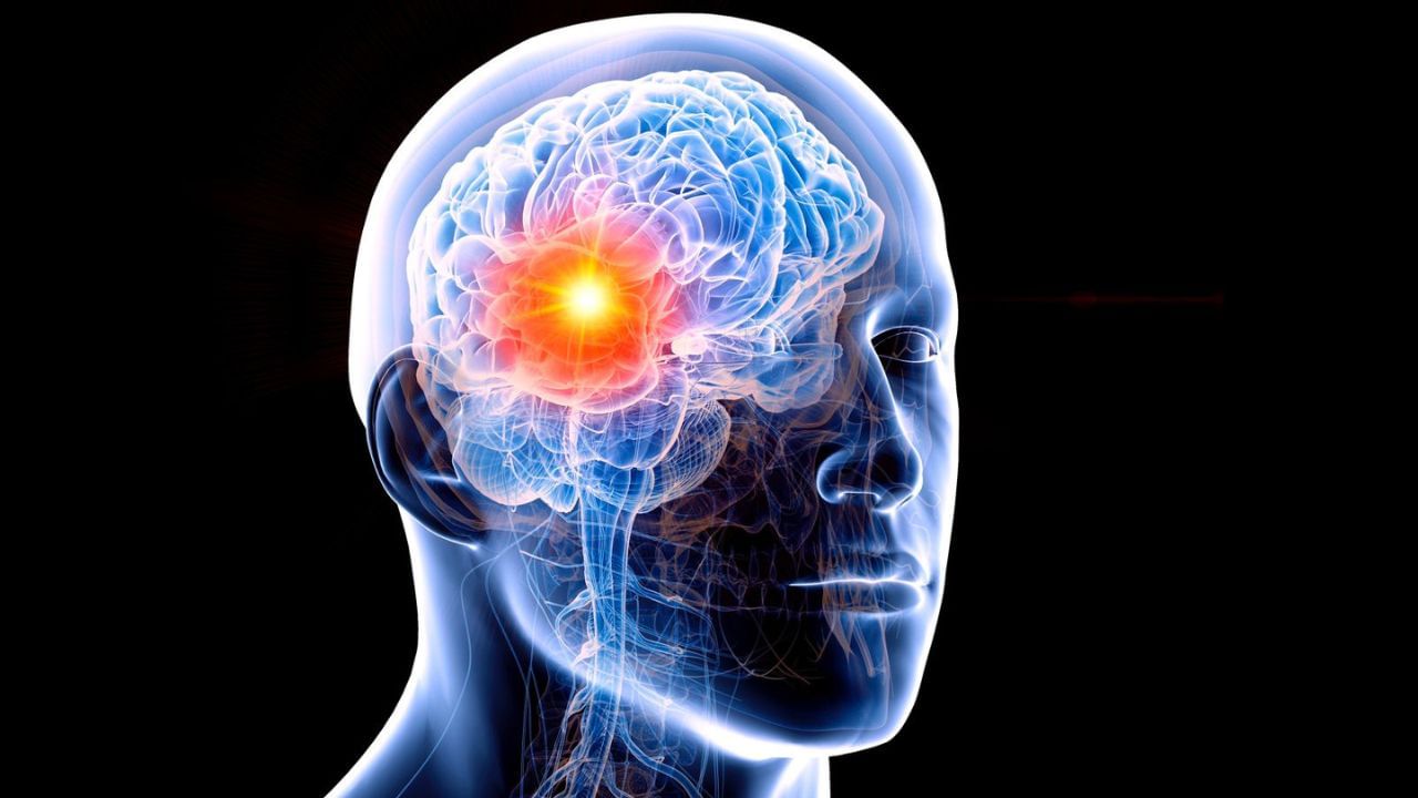 ब्रेन ट्यूमर के शुरुआती लक्षण क्या हैं? कैसे करें पहचान ब्रेन ट्यूमर के शुरुआती लक्षण क्या हैं? कैसे करें पहचान