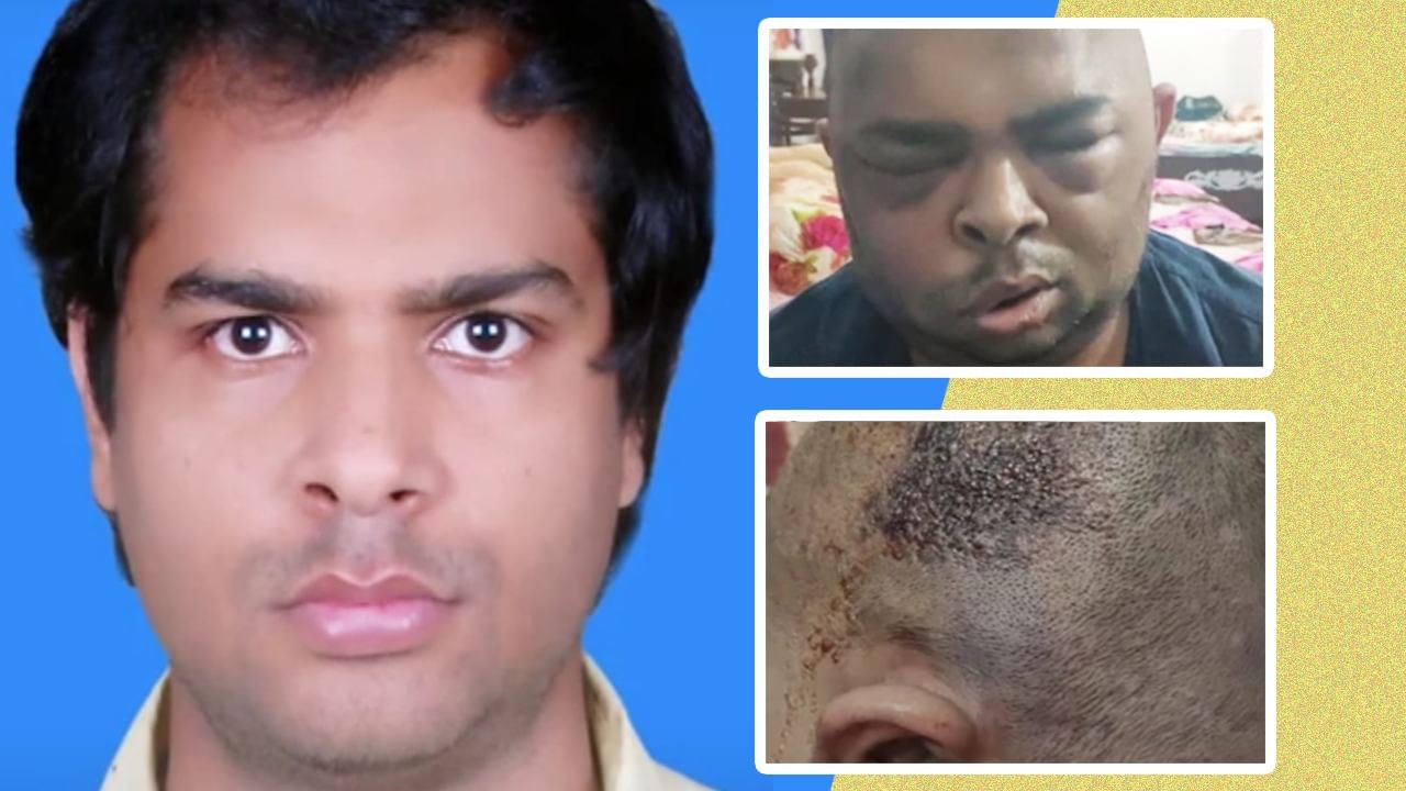 'बिना ड्रिगी की डॉक्टर है अनुष्का...', कानपुर में हेयर ट्रांसप्लांट से दूसरी मौत, इंजीनियर मयंक के परिजनों ने लगाया गंभीर आरोप 'बिना ड्रिगी की डॉक्टर है अनुष्का...', कानपुर में हेयर ट्रांसप्लांट से दूसरी मौत, इंजीनियर मयंक के परिजनों ने लगाया गंभीर आरोप