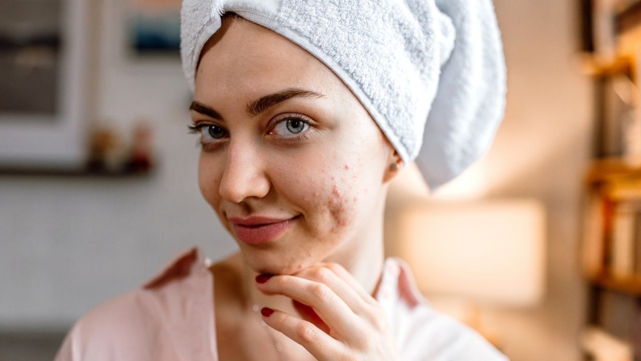 Chandan Facepack For Pimple Remove